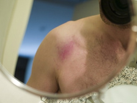 รอยช้ำโผล่ไม่รู้สาเหตุ ระวังมะเร็ง!